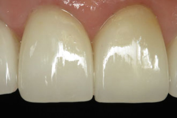 Battle Ground Cosmetic Dentist