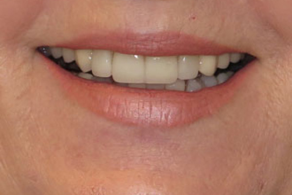 Teeth Replacement Battle Ground