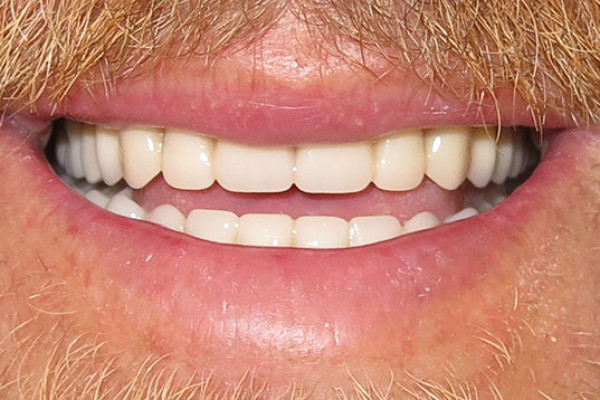 Battle Ground Full Mouth Reconstruction