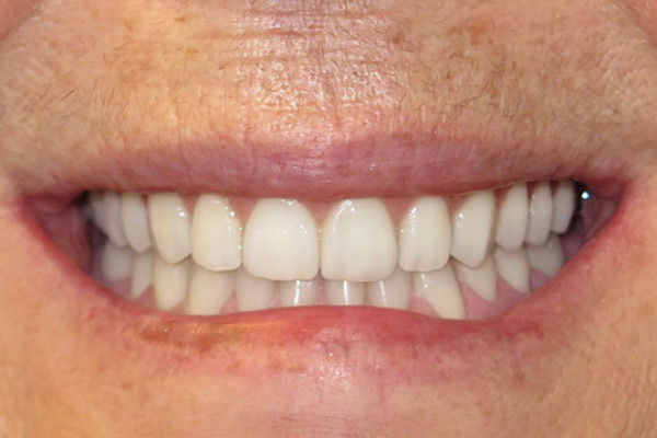 Dental Implants Dentist Battle Ground