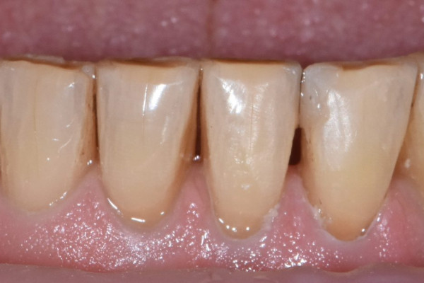 Battle Ground Cosmetic Dentist