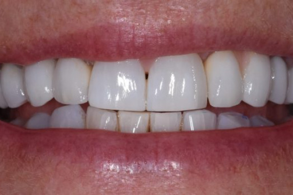 Battle Ground Full Mouth Reconstruction