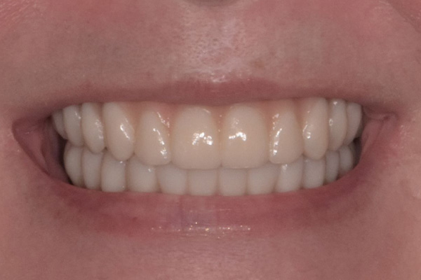 Above & Beyond Dentistry & Implants | Tooth Colored Fillings, Extractions and Full Mouth Reconstruction