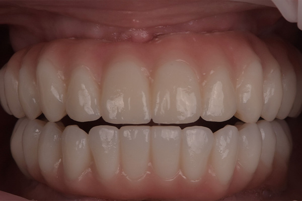 Above & Beyond Dentistry & Implants | Bridges, Dentures and TMJ & TMD
