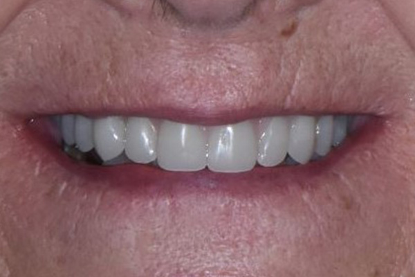 Above & Beyond Dentistry & Implants | Extractions, TMJ & TMD and All-on-X