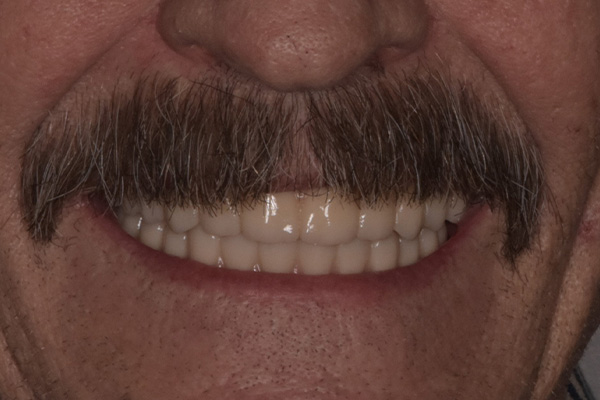 Above & Beyond Dentistry & Implants | Gum Disease, Wisdom Teeth Extractions and Dentures