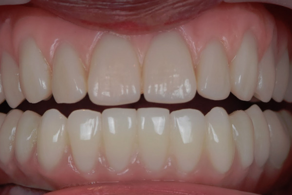 Above & Beyond Dentistry & Implants | All-on-X®, Wisdom Teeth Extractions and Bridges