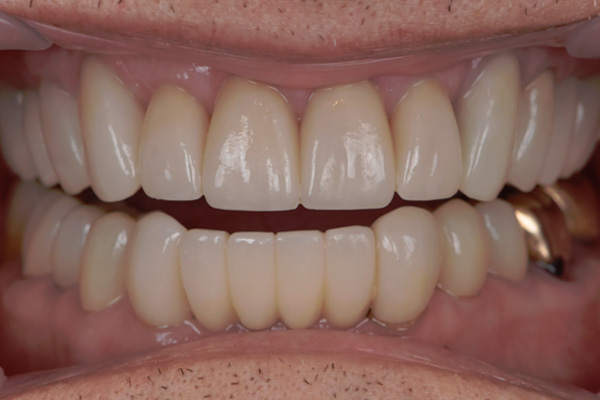 Above & Beyond Dentistry & Implants | Tooth Colored Fillings, Root Canals and Full Mouth Reconstruction