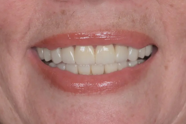 Above & Beyond Dentistry & Implants | Root Canals, Veneers and Extractions