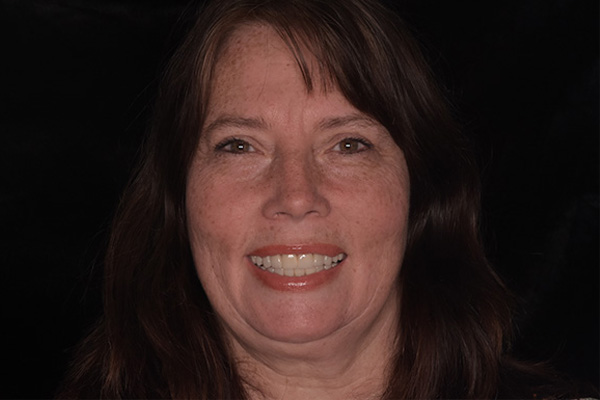 Above & Beyond Dentistry & Implants | Teeth Whitening, Extractions and Veneers