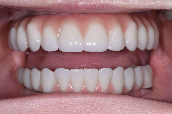 Above & Beyond Dentistry & Implants | Wisdom Teeth Extractions, Sedation Dentistry and Dentures