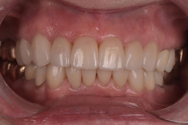 Above & Beyond Dentistry & Implants | Oral Hygiene, Wisdom Teeth Extractions and Crowns