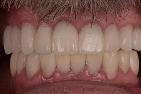 Above & Beyond Dentistry & Implants | Root Canals, All-on-X® and Extractions