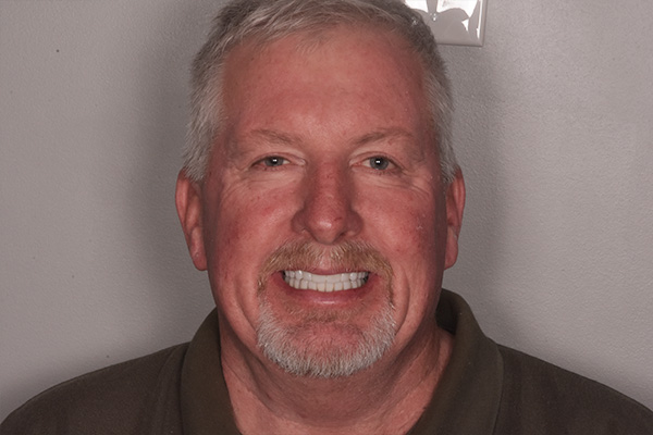 Above & Beyond Dentistry & Implants | Bridges, Chao Pinhole® Gum Rejuvenation and Root Canals