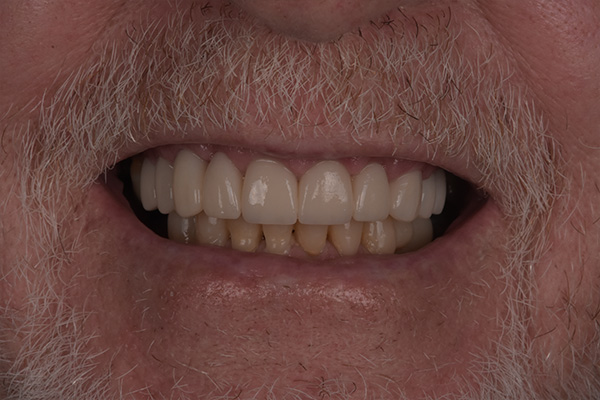 Above & Beyond Dentistry & Implants | TMJ & TMD, Veneers and Teeth Whitening