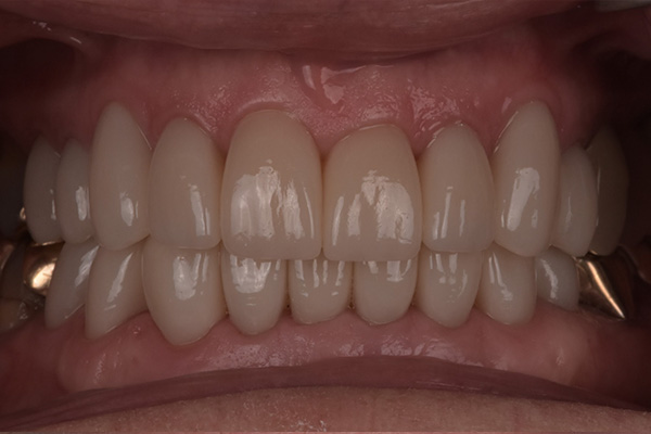Above & Beyond Dentistry & Implants | TMJ & TMD, All-on-X® and Root Canals