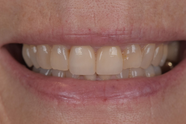 Above & Beyond Dentistry & Implants | Bone Grafting, Extractions and Dental Implants