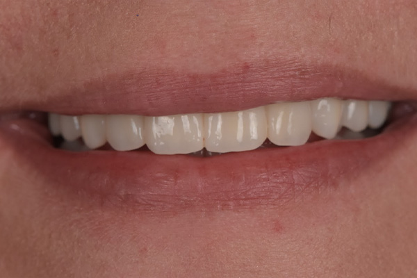 Above & Beyond Dentistry & Implants | Chao Pinhole® Gum Rejuvenation, Extractions and Dentures