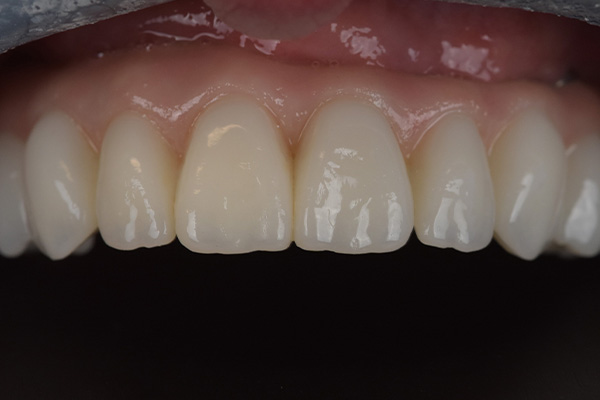 Above & Beyond Dentistry & Implants | Oral Hygiene, Crowns and Chao Pinhole® Gum Rejuvenation