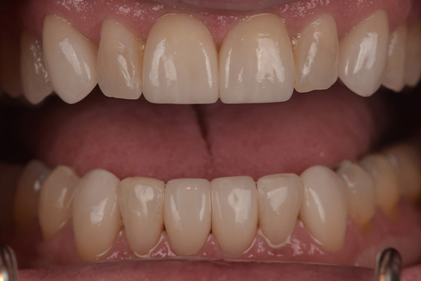 Above & Beyond Dentistry & Implants | TMJ & TMD, Wisdom Teeth Extractions and Oral Hygiene