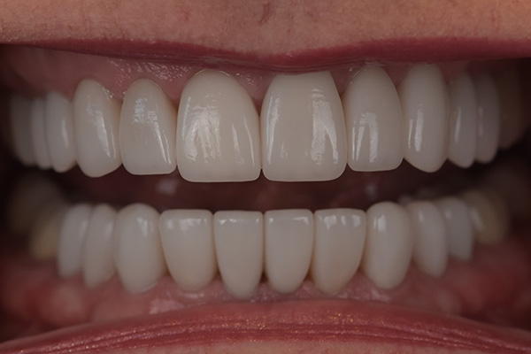 Above & Beyond Dentistry & Implants | Dental Implants, Wisdom Teeth Extractions and TMJ & TMD