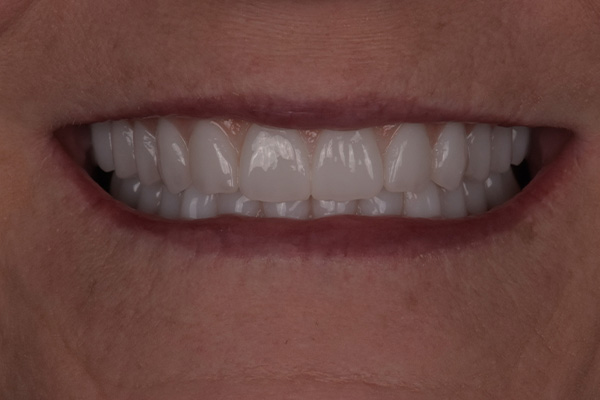 Above Beyond Dentistry Implants | Extractions, All-on-X reg and Bone Grafting
