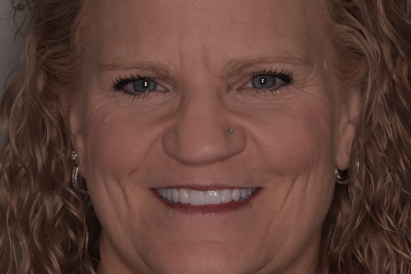 Above Beyond Dentistry Implants | Bone Grafting, Wisdom Teeth Extractions and Full Mouth Reconstruction