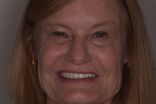 Above Beyond Dentistry Implants | Extractions, Root Canals and Tooth Colored Fillings