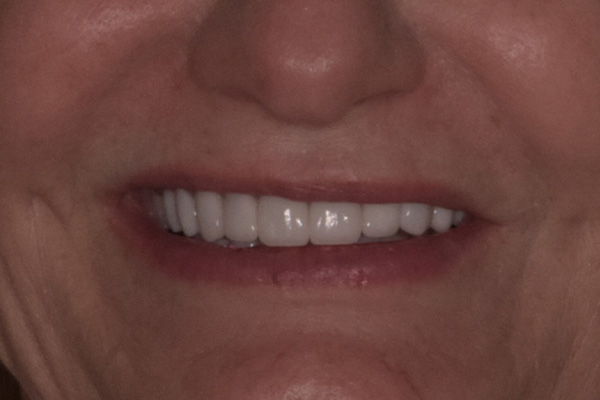Above Beyond Dentistry Implants | Bone Grafting, Teeth Whitening and Root Canals
