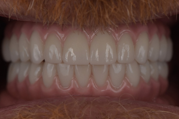 Above Beyond Dentistry Implants | Sedation Dentistry, Oral Hygiene and Bone Grafting