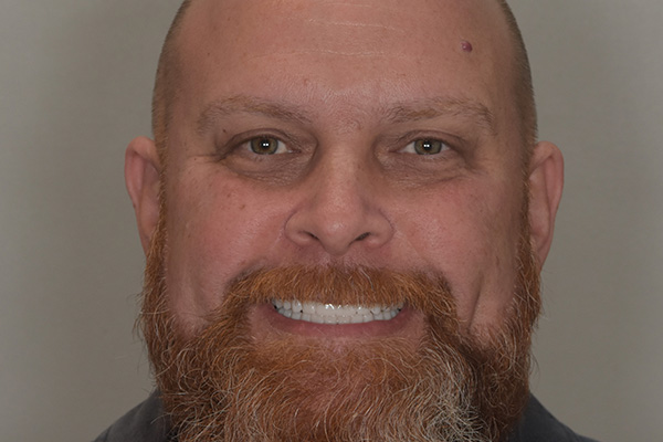 Above Beyond Dentistry Implants | Veneers, Bone Grafting and Full Mouth Reconstruction