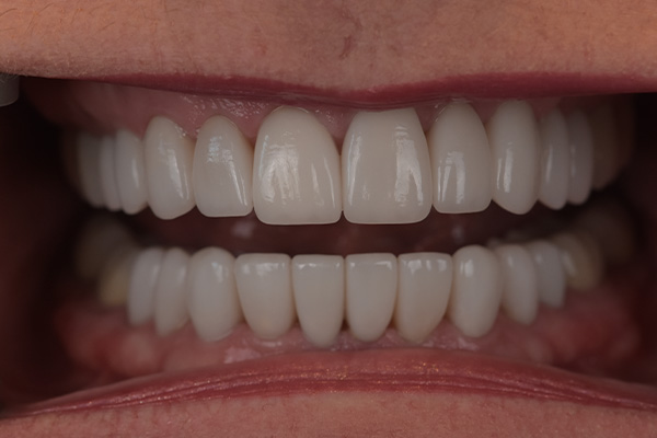 Above Beyond Dentistry Implants | Teeth Whitening, Dental Implants and Bridges