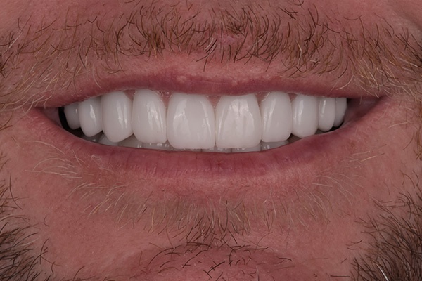 Above & Beyond Dentistry & Implants | TMJ & TMD, Oral Hygiene and Tooth Colored Fillings