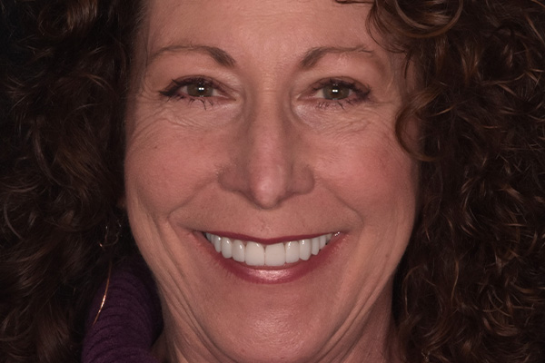 Above Beyond Dentistry Implants | Chao Pinhole reg Gum Rejuvenation, Wisdom Teeth Extractions and Full Mouth Reconstruction