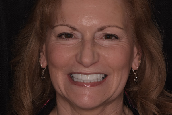 Above & Beyond Dentistry & Implants | Oral Hygiene, Wisdom Teeth Extractions and Chao Pinhole® Gum Rejuvenation