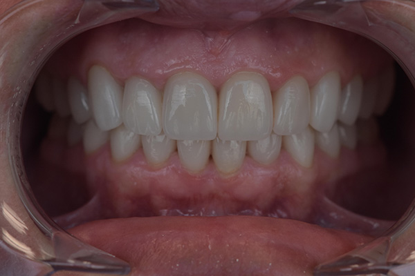 Above Beyond Dentistry Implants | Dental Implants, Root Canals and Teeth Whitening