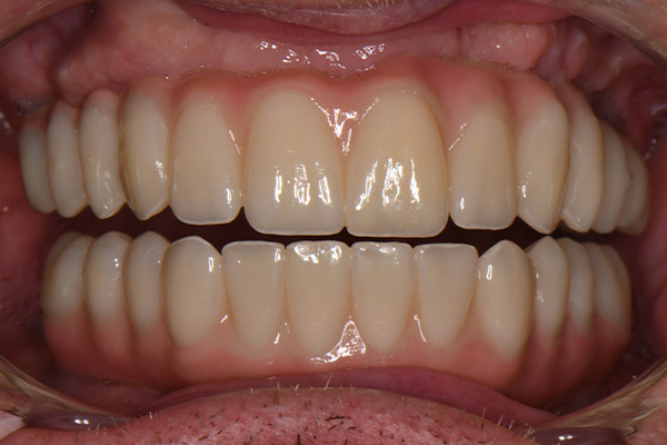 Above Beyond Dentistry Implants | Chao Pinhole reg Gum Rejuvenation, Full Mouth Reconstruction and Bone Grafting