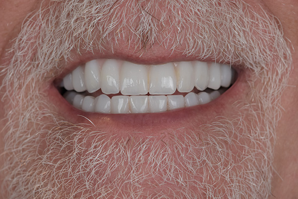 Above Beyond Dentistry Implants | Root Canals, All-on-X reg and Gum Disease