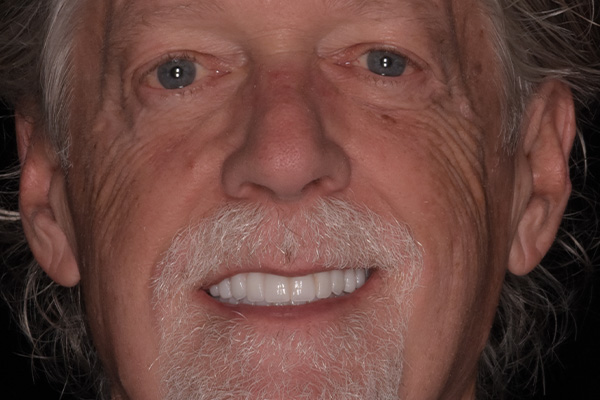 Above Beyond Dentistry Implants | Tooth Colored Fillings, Crowns and Oral Hygiene