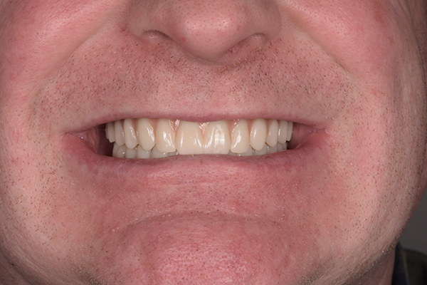 Above & Beyond Dentistry & Implants | Gum Disease, Chao Pinhole&reg; Gum Rejuvenation and Bridges