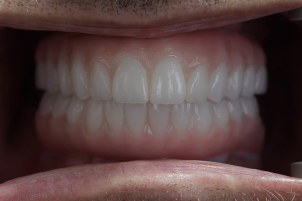 Above & Beyond Dentistry & Implants | Chao Pinhole® Gum Rejuvenation, Dentures and Oral Hygiene