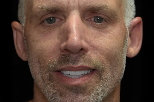 Above & Beyond Dentistry & Implants | Veneers, Full Mouth Reconstruction and Bone Grafting