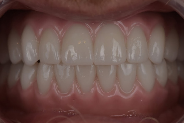 Above Beyond Dentistry Implants | Bridges, All-on-X reg and Dentures