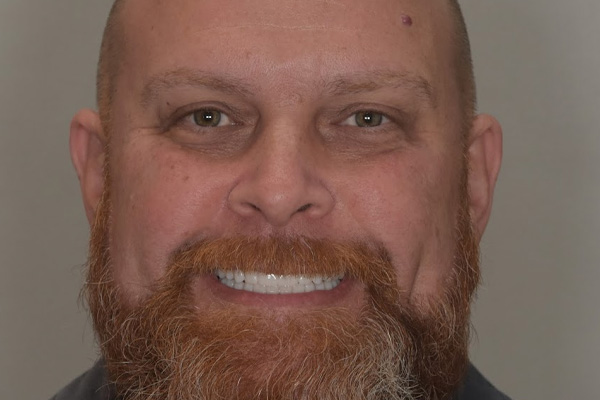 Above & Beyond Dentistry & Implants | Teeth Whitening, Veneers and Root Canals