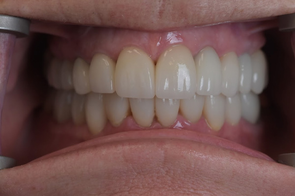 Above Beyond Dentistry Implants | Root Canals, Dental Implants and Veneers