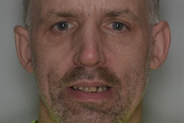 Above & Beyond Dentistry & Implants | Oral Hygiene, Gum Disease and Chao Pinhole® Gum Rejuvenation