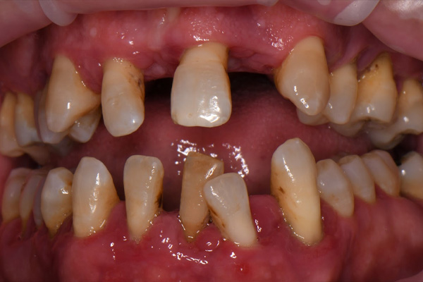 Above Beyond Dentistry Implants | Tooth Colored Fillings, Dental Implants and Extractions