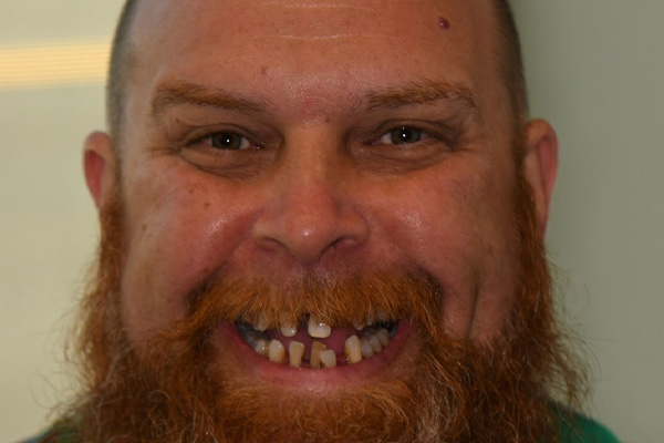 Above & Beyond Dentistry & Implants | Crowns, Chao Pinhole® Gum Rejuvenation and Dentures