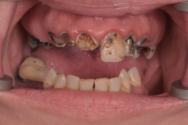 Above Beyond Dentistry Implants | Gum Disease, Sedation Dentistry and Chao Pinhole reg Gum Rejuvenation