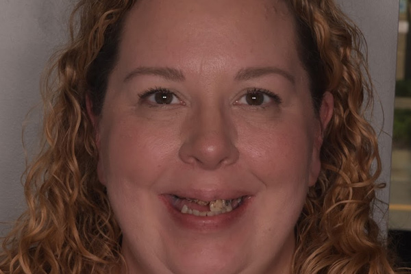 Above Beyond Dentistry Implants | Chao Pinhole reg Gum Rejuvenation, Root Canals and Wisdom Teeth Extractions